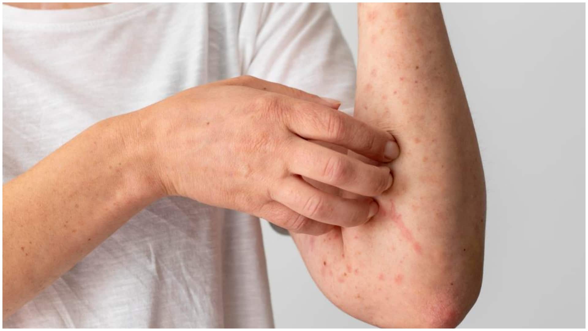 Peste 13.000 de cazuri de rujeolă. Ultimul deces a fost înregistrat în Giurgiu, o femeie de 34 de ani a murit